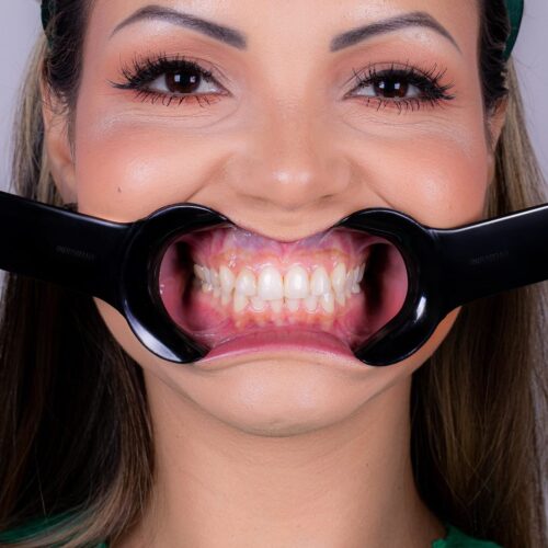 C Shape Retractors for Occlusion Black Photography - Image 2