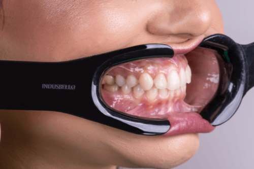 Indusbello V2 Lip Retractor Model-Black-2- Unit-Adult - Image 2