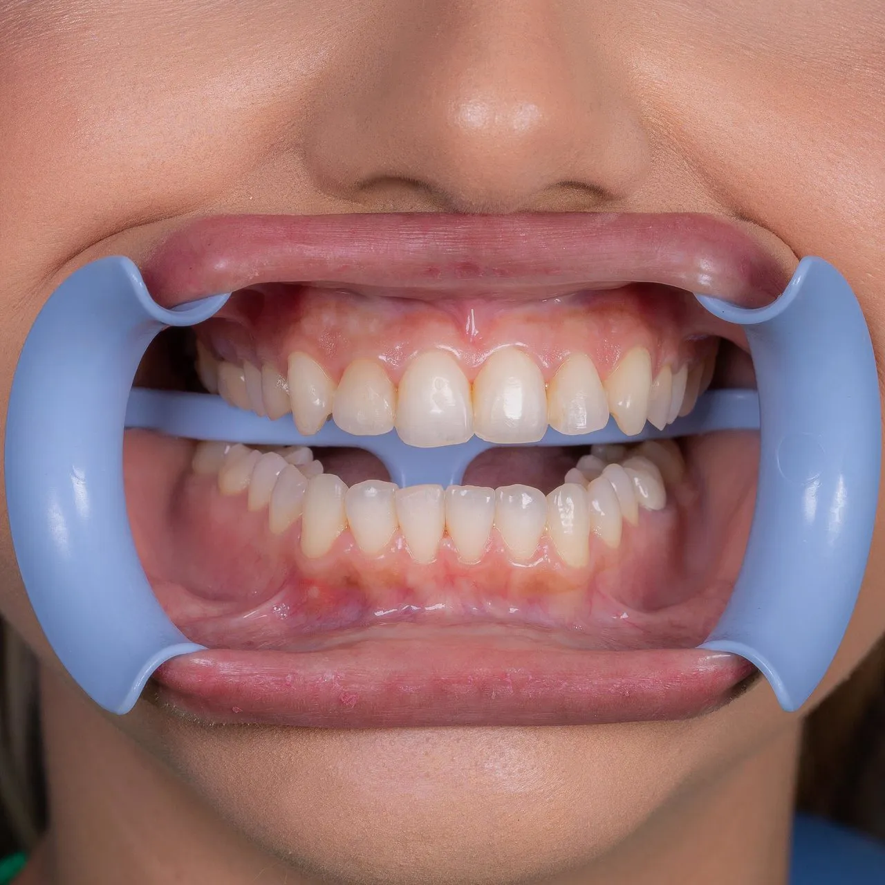 Indusbello Lip and Tongue  Expander - Image 2